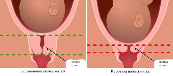 Короткая шейка матки – проявление истмико-цервикальной недостаточности.